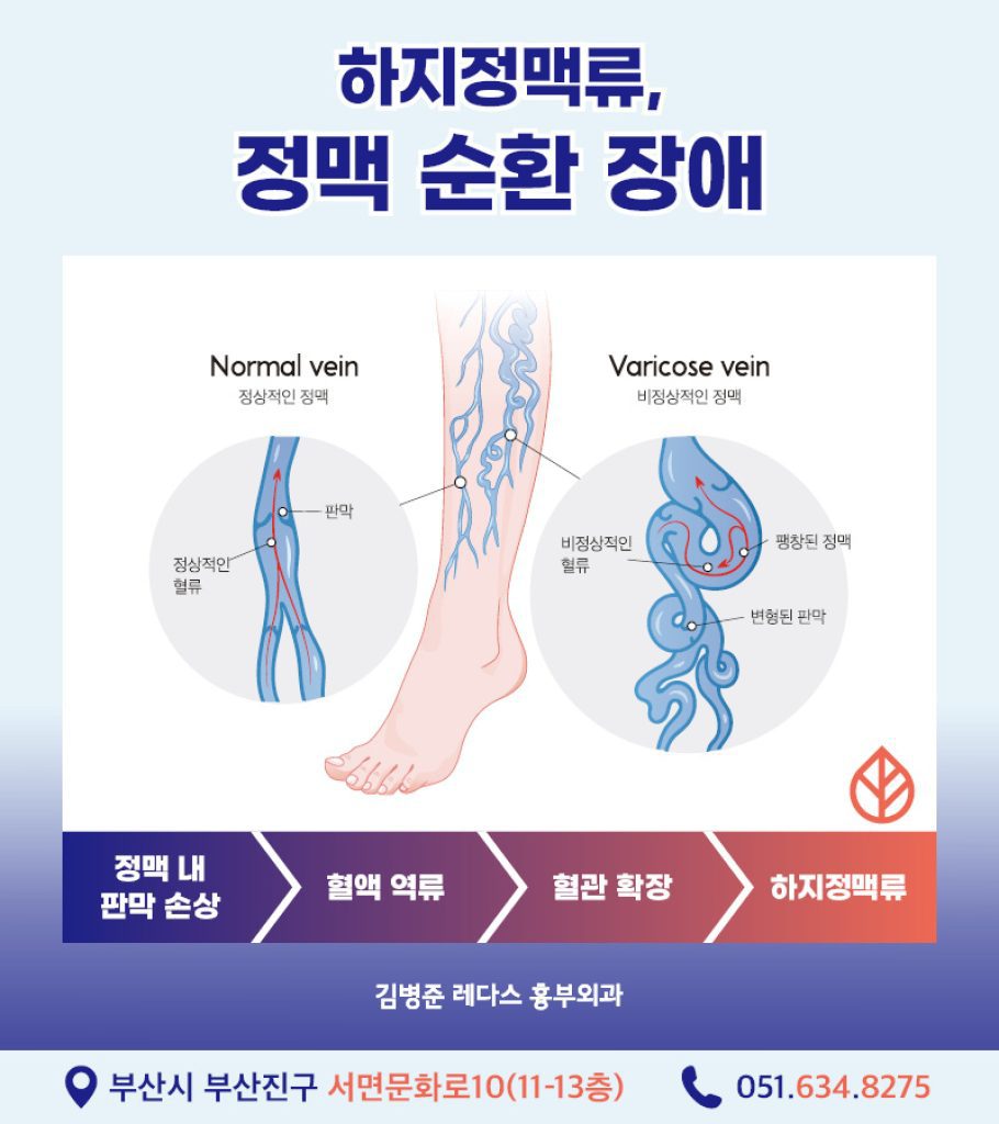 50대하지정맥류 하지정맥류란 다리의 정맥 혈액이 정상적으로 순환하지 못하고, 혈액이 역류하는 질환입니다.