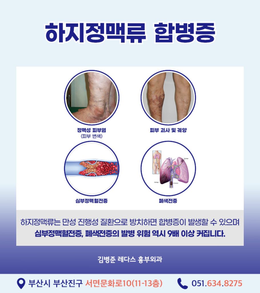 다리통증을 근골격계 질환으로 오인할 수 있는 하지정맥류 증상