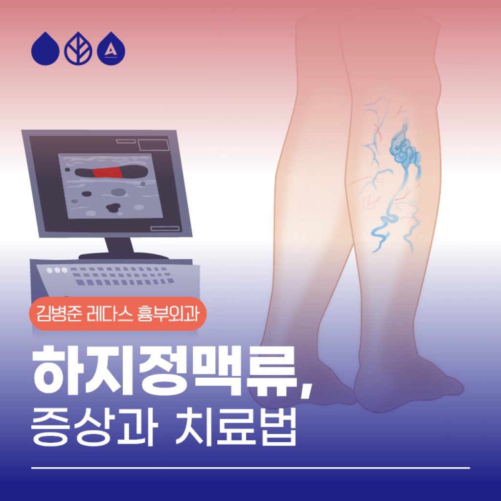하지정맥류치료법 혈관 돌출은 하지정맥류 증상 중 하나이므로, 눈에 보이는 혈관 돌출이 없더라도 다리 무거움, 피로감, 통증, 부종, 야간 근육경련 등의 증상이 있다면 하지정맥류를 의심해볼 필요가 있습니다.