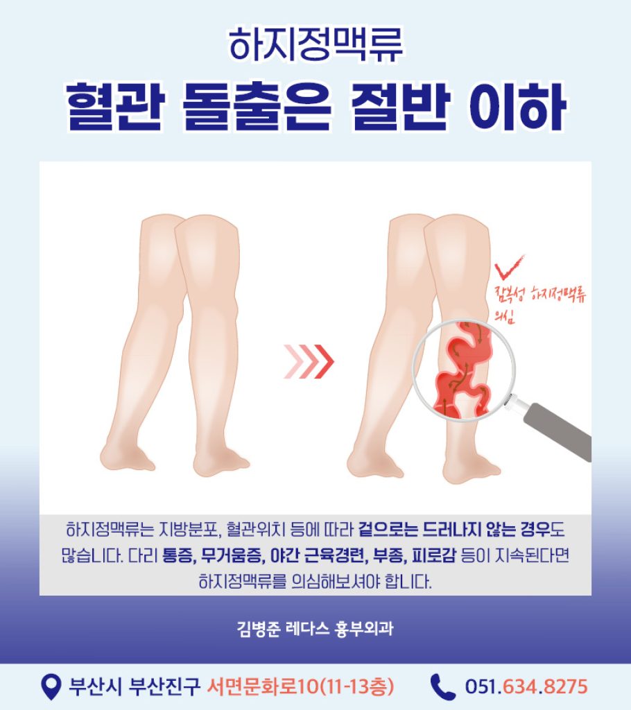 하지정맥류치료법 혈관 돌출은 하지정맥류 증상 중 하나이므로, 눈에 보이는 혈관 돌출이 없더라도 다리 무거움, 피로감, 통증, 부종, 야간 근육경련 등의 증상이 있다면 하지정맥류를 의심해볼 필요가 있습니다.