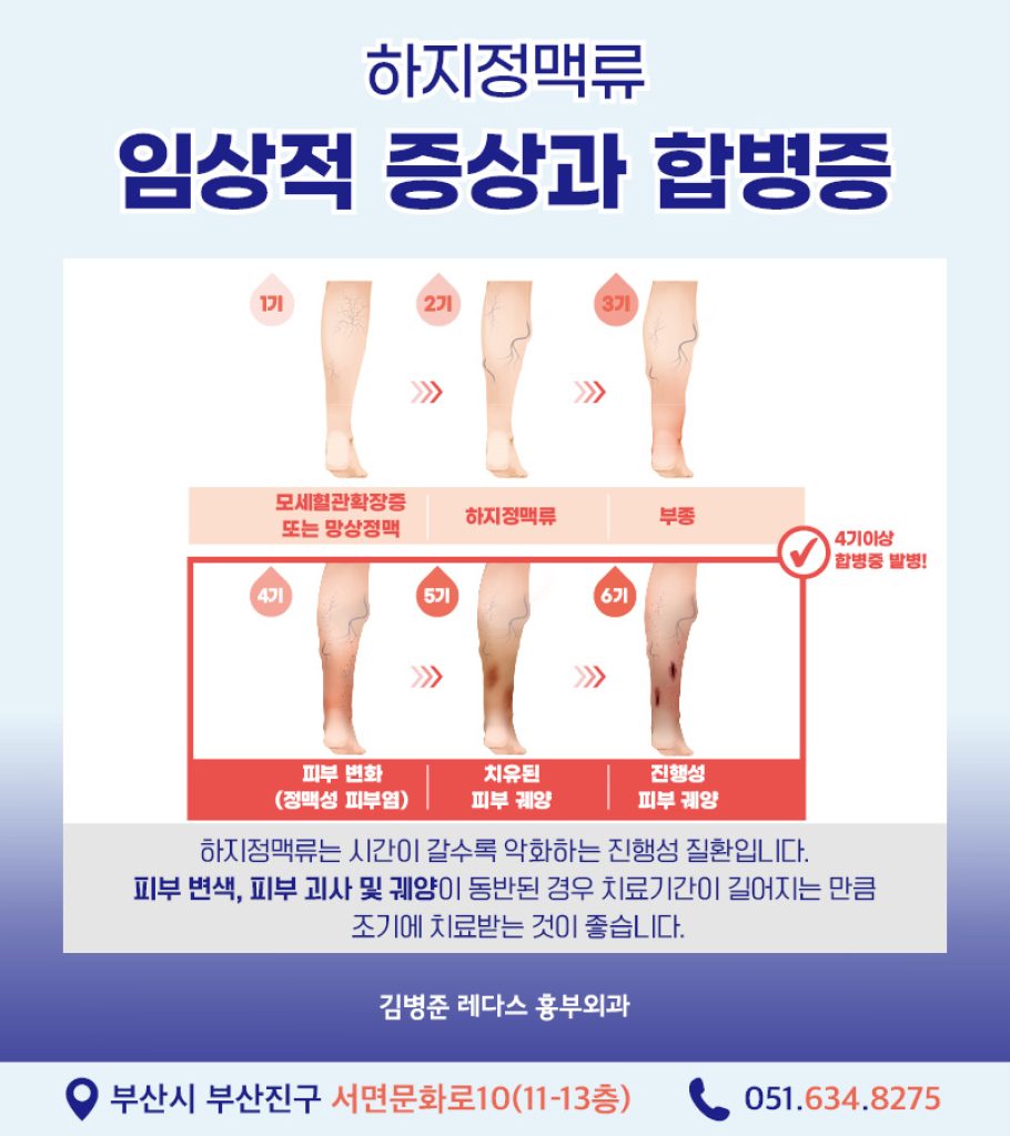 혈관 돌출은 하지정맥류 증상 중 하나이므로, 눈에 보이는 혈관 돌출이 없더라도 다리 무거움, 피로감, 통증, 부종, 야간 근육경련 등의 증상이 있다면 하지정맥류를 의심해볼 필요가 있습니다.