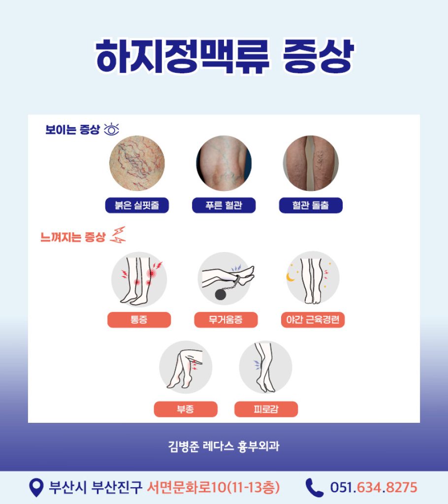 다리저림 하지정맥류의 대표적인 증상으로 울퉁불퉁하게 튀어나온 혈관을 떠올리는 경우가 많습니다. 