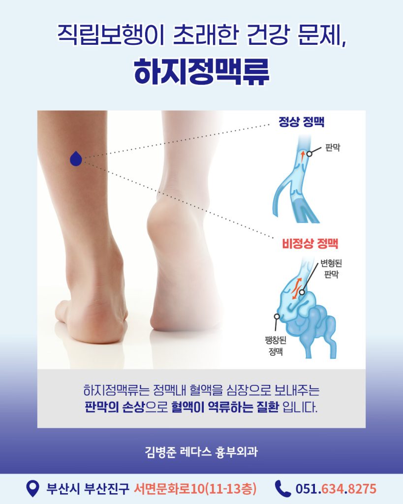 잠복성하지정맥류 가장 잘 알려진 증상은 다리에 구불구불하게 튀어나온 혈관의 돌출입니다. 하지만 하지정맥류 환자 중 혈관 돌출을 경험한 환자는 절반도 되지 않는데요. 