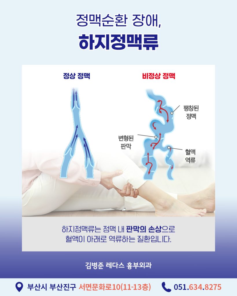 여름하지정맥류 다리 통증을 부르는 질환에는 허리디스크, 협착증, 관절염, 근육통 등 다양한 질환이 있는데요. 그중에서 여름철 높은 기온으로 인해 증상이 심해졌다면 하지정맥류를 의심해보셔야 합니다.