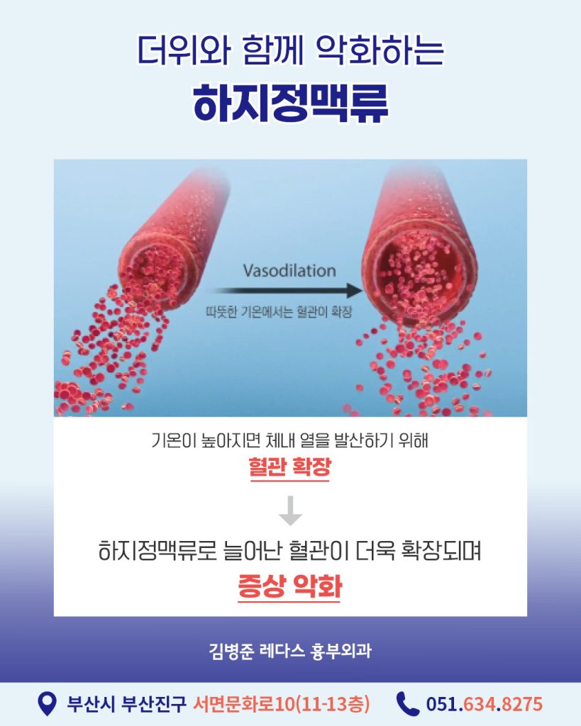 여름하지정맥류 다리 통증을 부르는 질환에는 허리디스크, 협착증, 관절염, 근육통 등 다양한 질환이 있는데요. 그중에서 여름철 높은 기온으로 인해 증상이 심해졌다면 하지정맥류를 의심해보셔야 합니다.