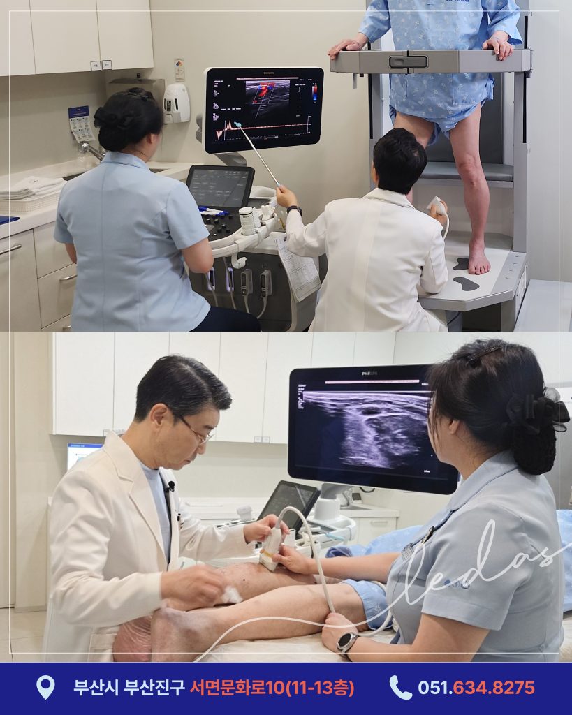 여름철 급증하는 하지정맥류 환자