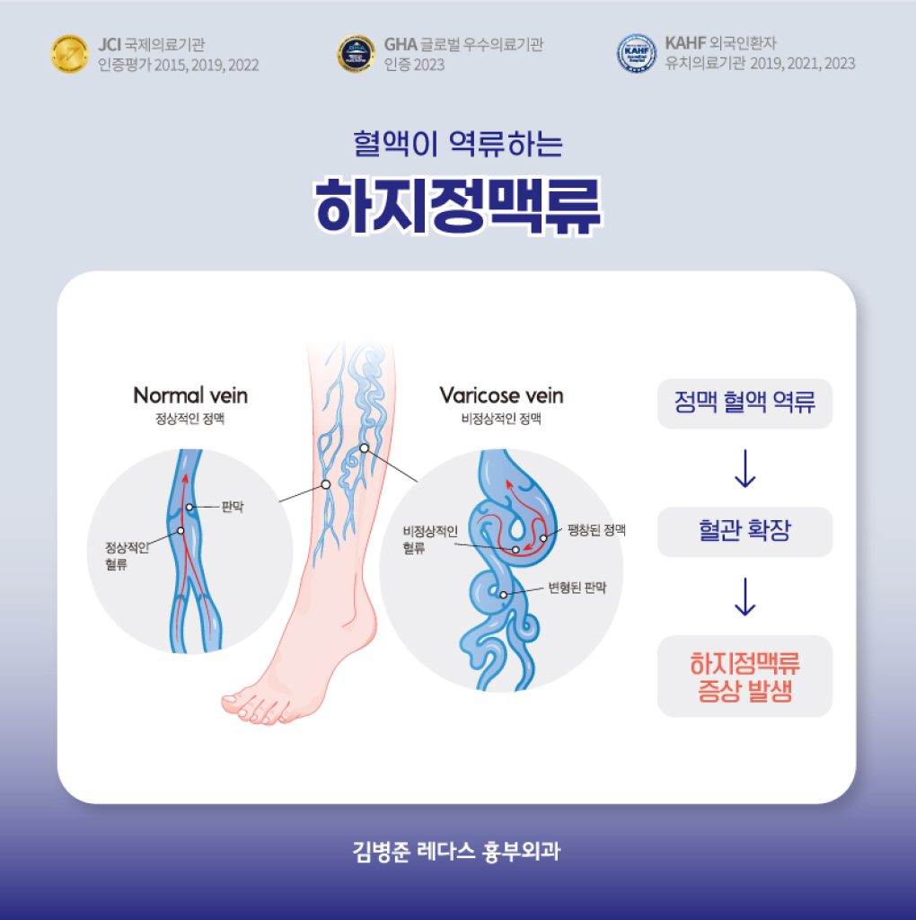 하지정맥류