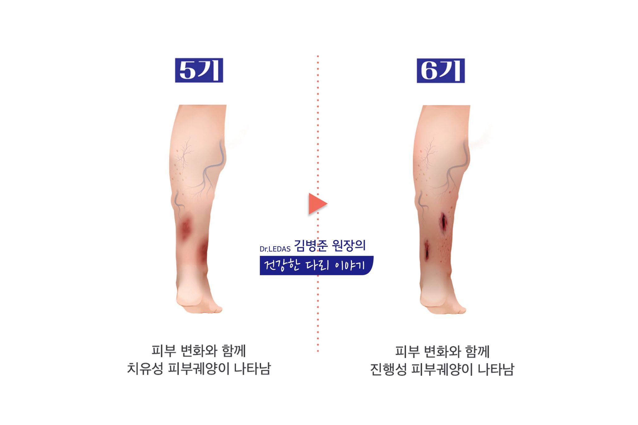 다리 피부 질환 정맥 혈관 문제일수도 - 김병준 원장의 건강한 다리 이야기