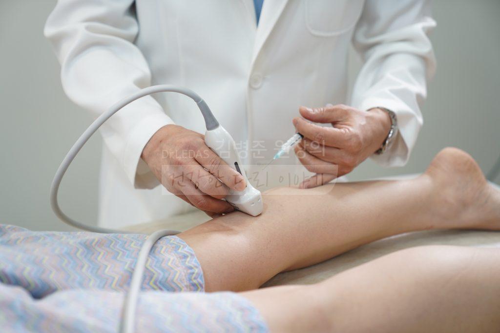 초음파 유도하 혈관경화요법