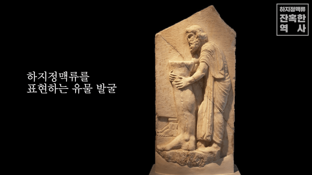 하지정맥류 유물