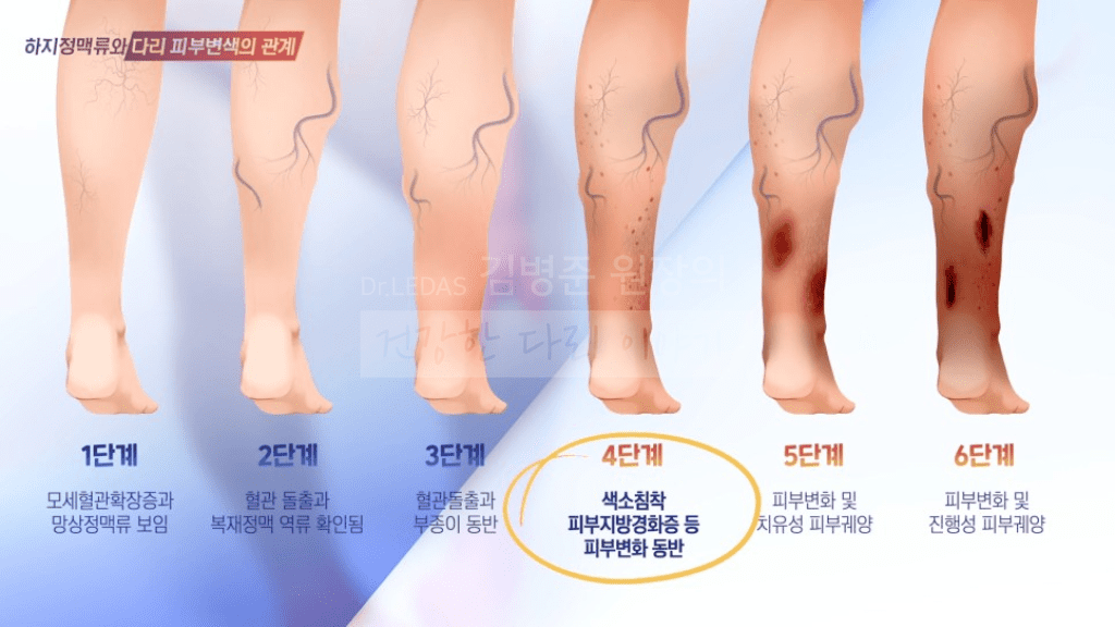하지정맥류 단계