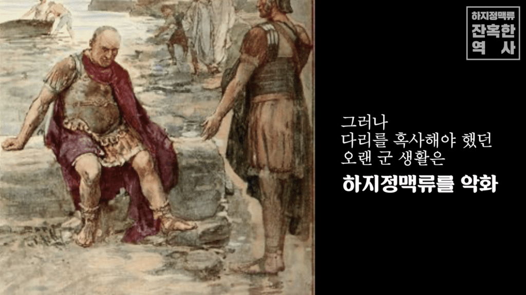 마리우스 장군 하지정맥류