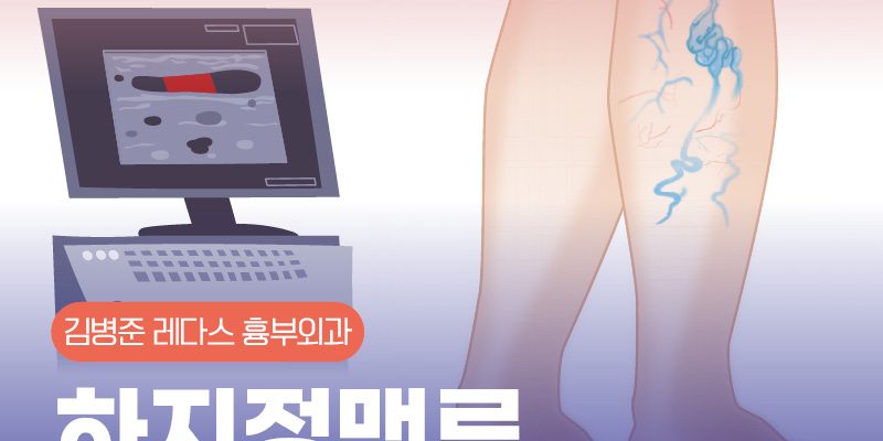 하지정맥류치료법 (레이저, 주사요법)