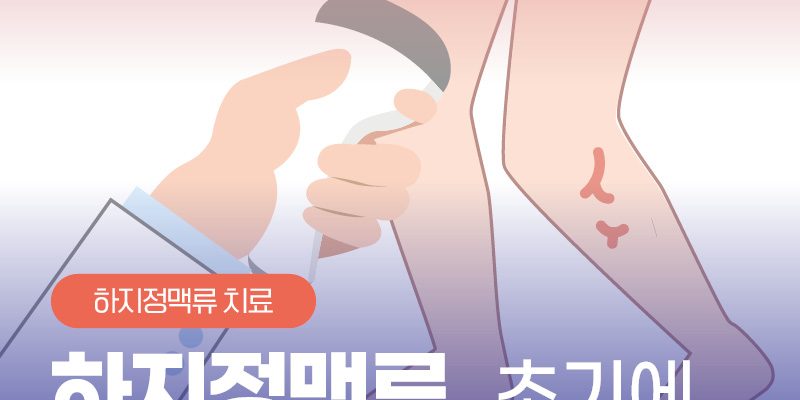 잠복성하지정맥류 초기에 치료해야 하는 이유