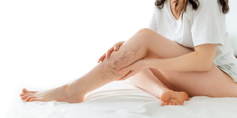 [부산하지정맥류] 수술 비용부터 마취 없는 비수술 치료까지 완벽 비교 Varicose Vein Treatment Costs