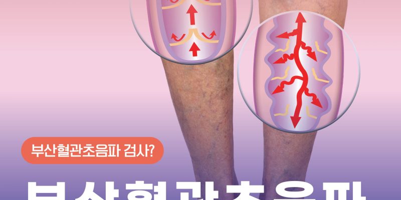 혈관초음파검사 하지정맥류 치료의 시작