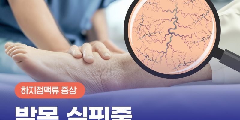 발목실핏줄 보인다면, 중증 하지정맥류 확인하세요