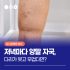 하지정맥류 병원선택 3단계 진단-치료-재발예방 관리까지