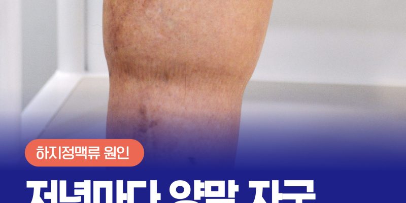 저녁마다 선명한 양말 자국, 붓고 무거운 다리 원인은? | 정맥성 다리 부종 Leg Edema