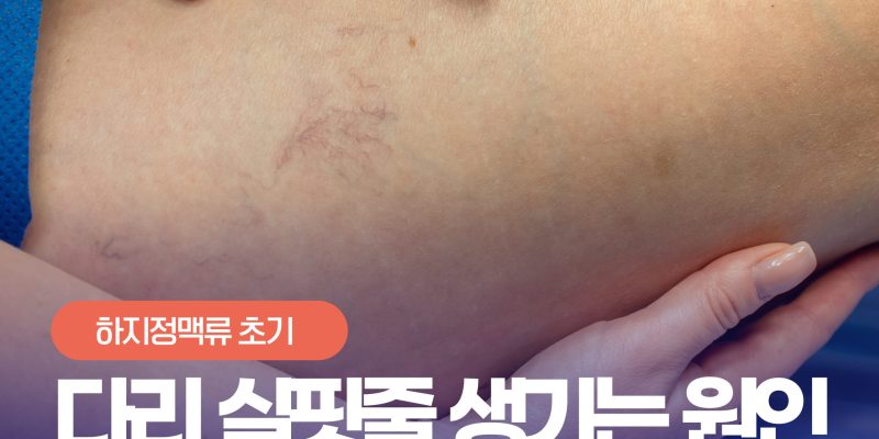 늘어나는 다리 실핏줄, 단순 피부 문제일까? 하지정맥류 초기증상 Leg spider veins