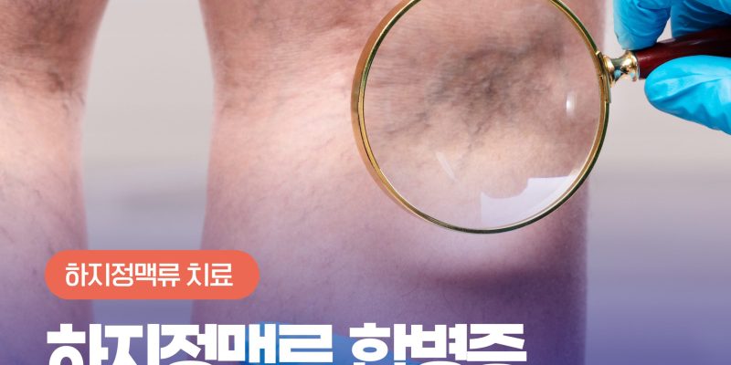 하지정맥류합병증 꼭 치료해야 하는 이유