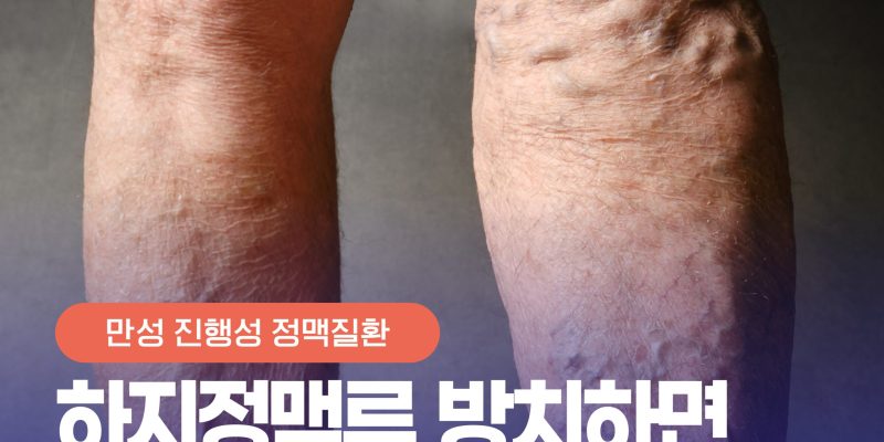 핏줄 안 보인다고 방치했다간 큰일? 하지정맥류 방치 시 다리에 미치는 영향 | Untreated Varicose Veins