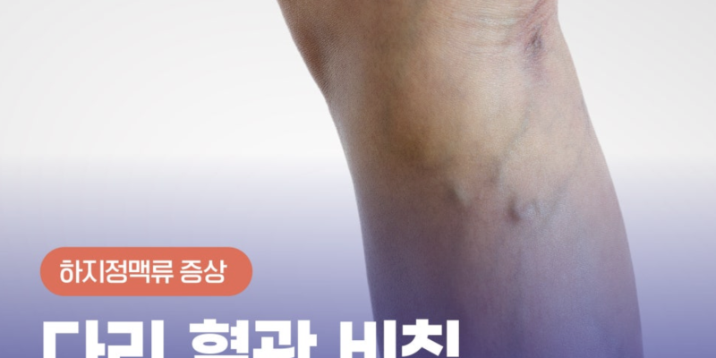 다리혈관비침 하지정맥류인가요?