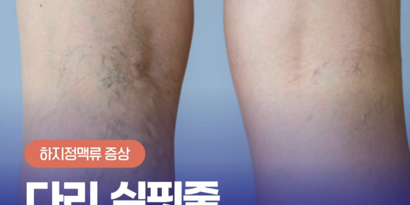하지정맥다리실핏줄 점점 퍼져나간다면 이 질환?