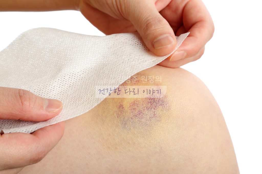 다리 멍 사진