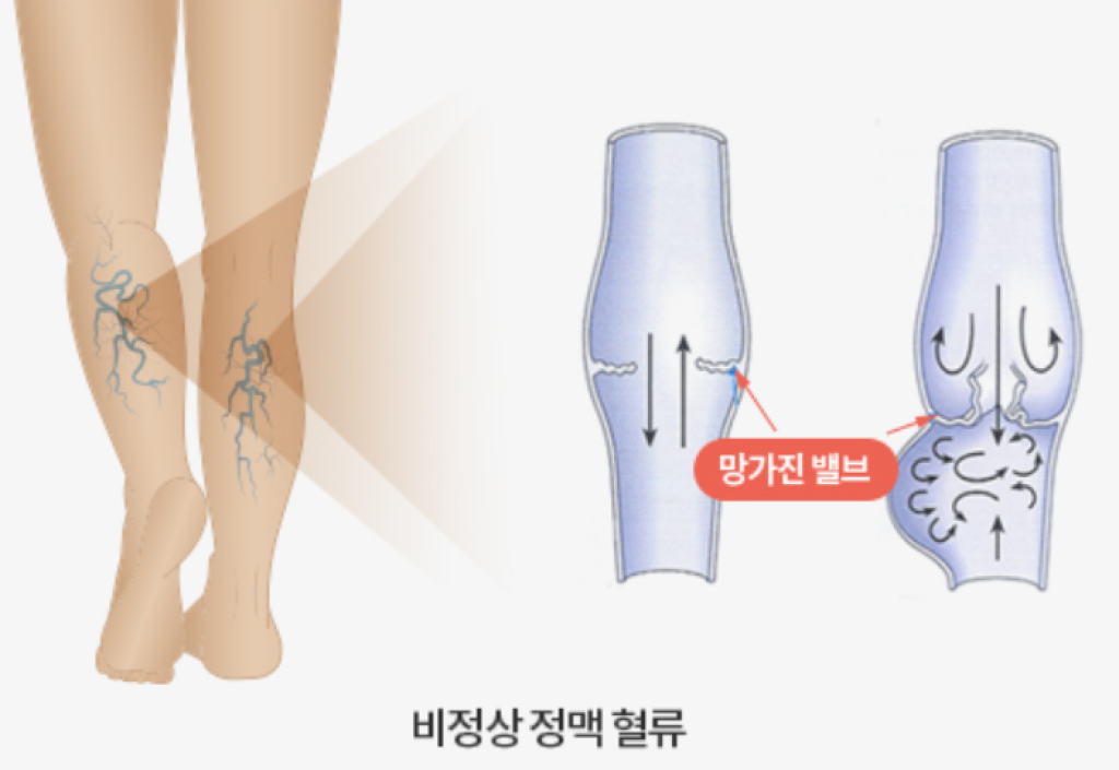다리 정맥 내부의 정상 판막과 고장 나서 혈액이 역류하는 판막