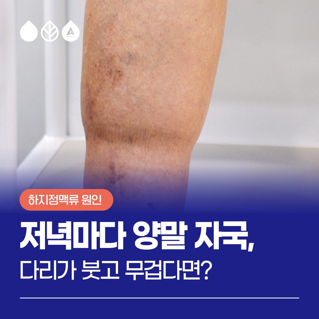 저녁마다 양말 자국이 남는 다리 부종
