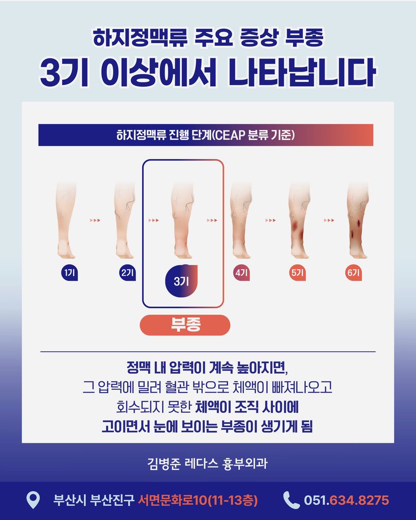 하지정맥류 3기 부종 증상