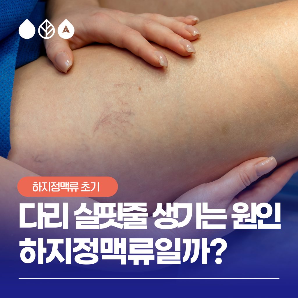 다리 실핏줄 생기는 원인은 하지정맥류