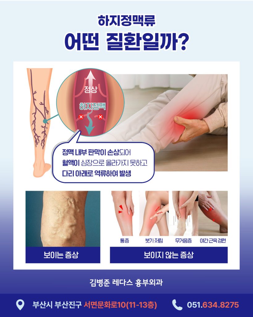 하지정맥치료방법 하지정맥류는 성인의 약 20~30%에서 발병한다고 알려질 정도로 흔한 혈관 질환입니다. 하지정맥류는 제때 치료하지 않았을 때 증상이 점차 악화되는 것