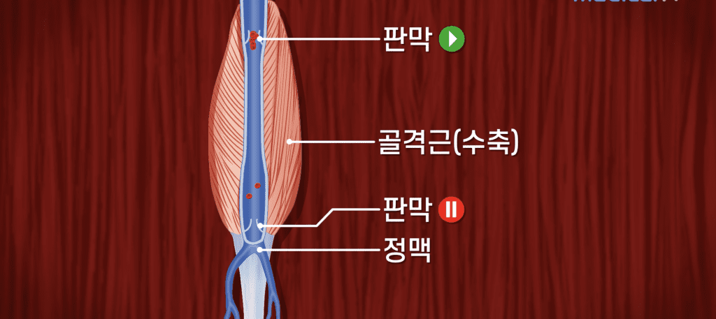 종아리 근육이 중요한 이유