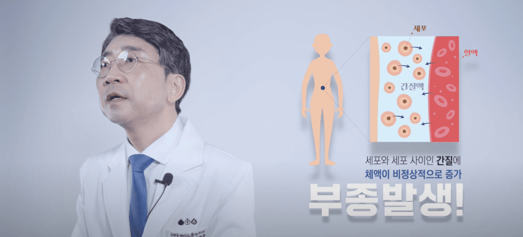 다리 부종 발생하는 이유, 세포와 세포 사이의 간질에 체액이 비정상적으로 증가하면 생길 수 있다.