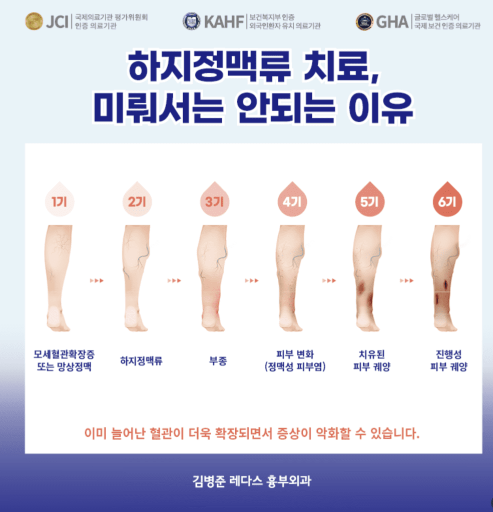 하지정맥류악화 치료 미뤄서는 안되는 이유는 방치하면 합병증 유발