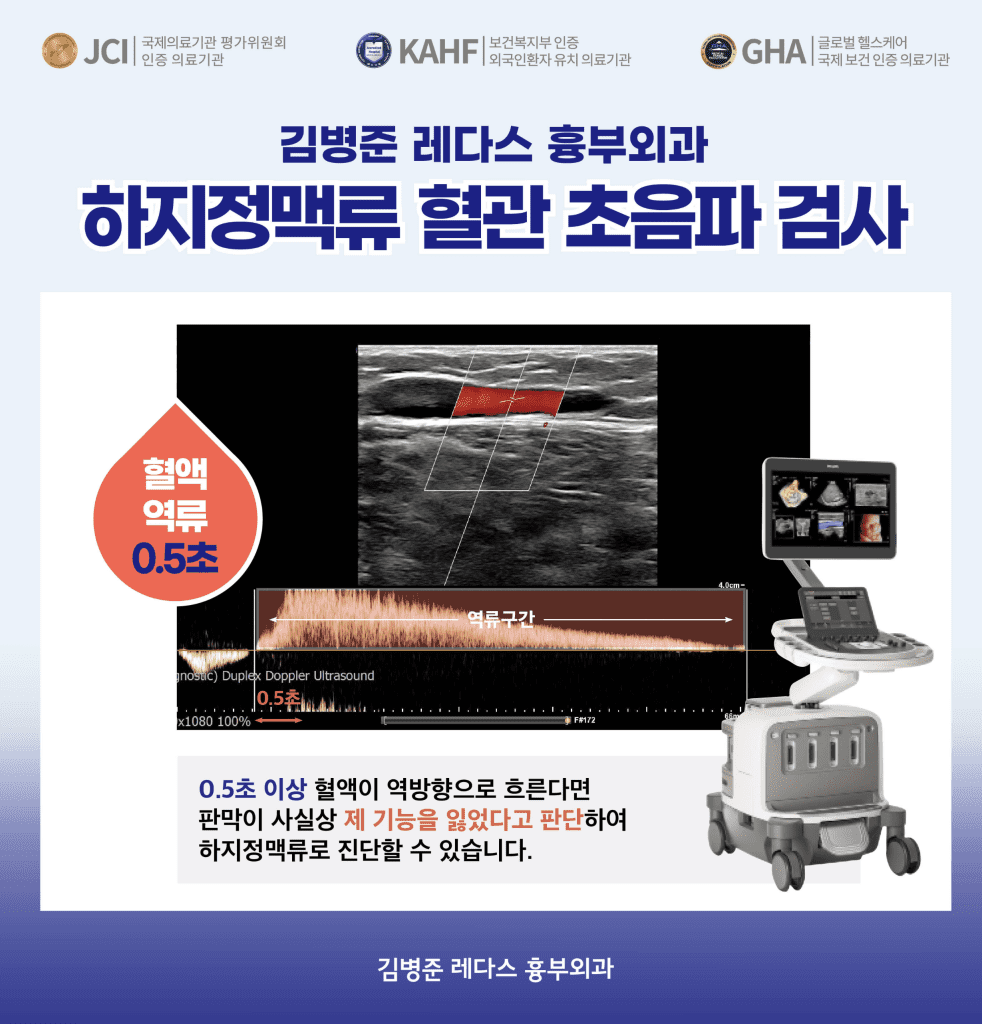 하지정맥류진단 하지정맥류 혈관 초음파 검사에서 0.5초 이상 혈액이 역방향으로 흐른다면 하지정맥류 진단.