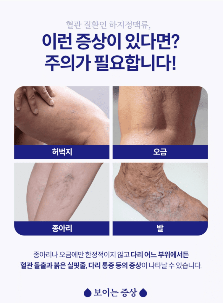 하지정맥류흉부외과 다리가 아프면 정형외과나 통증의학과, 신경과, 한의원을 먼저 떠올리는 경우가 많은데요. 그러나 하지정맥류로 의한 증상이라면, 진단과 치료를 받는 것이 더 적합할 수 있습니다. 흉부와 하지, 언뜻 연관성이 없어 보일 수 있는데요. 
