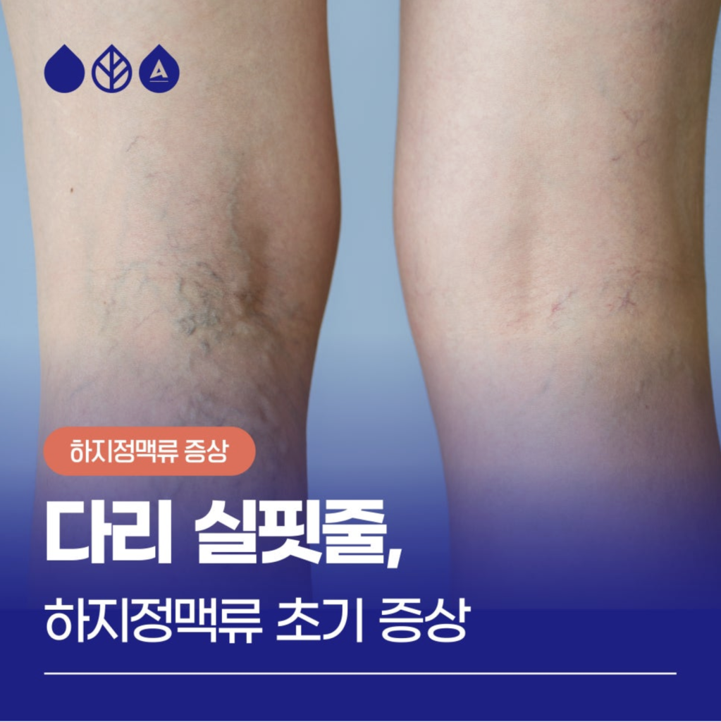 이전에는 심하지 않았던 다리실핏줄이 점점 퍼져나간다면, 또 푸른 혈관이 도드라져 보이거나 울퉁불퉁 튀어나온다면 하지정맥류를 의심해보셔야 합니다. 오늘은 눈에 띄는 다리실핏줄 의 원인 하지정맥류에 대해 알려드리겠습니다.
