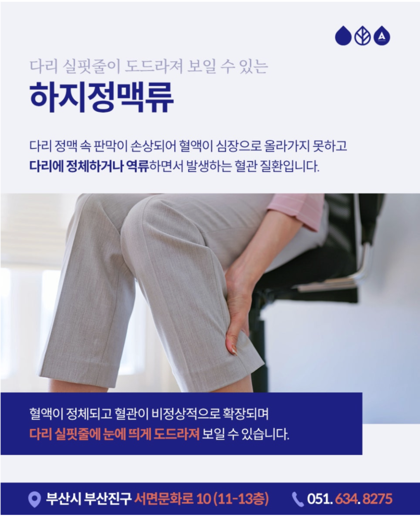 이전에는 심하지 않았던 다리실핏줄이 점점 퍼져나간다면, 또 푸른 혈관이 도드라져 보이거나 울퉁불퉁 튀어나온다면 하지정맥류를 의심해보셔야 합니다. 오늘은 눈에 띄는 다리실핏줄 의 원인 하지정맥류에 대해 알려드리겠습니다.