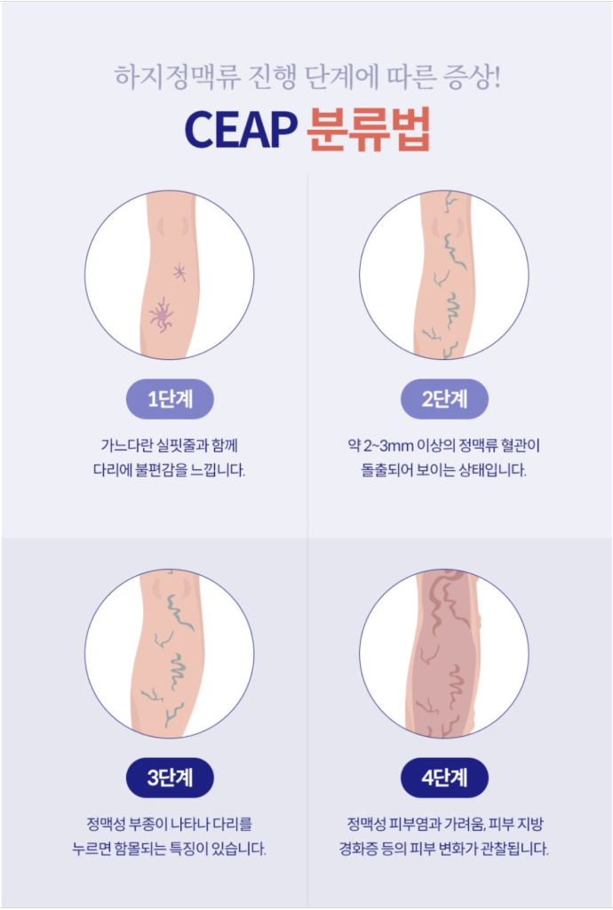 이전에는 심하지 않았던 다리실핏줄이 점점 퍼져나간다면, 또 푸른 혈관이 도드라져 보이거나 울퉁불퉁 튀어나온다면 하지정맥류를 의심해보셔야 합니다. 오늘은 눈에 띄는 다리실핏줄 의 원인 하지정맥류에 대해 알려드리겠습니다.