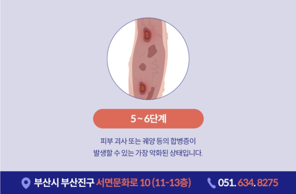 하지정맥다리실핏줄 이전에는 심하지 않았던 다리실핏줄 이 점점 퍼져나간다면, 또 푸른 혈관이 도드라져 보이거나 울퉁불퉁 튀어나온다면 하지정맥류를 의심해보셔야 합니다.