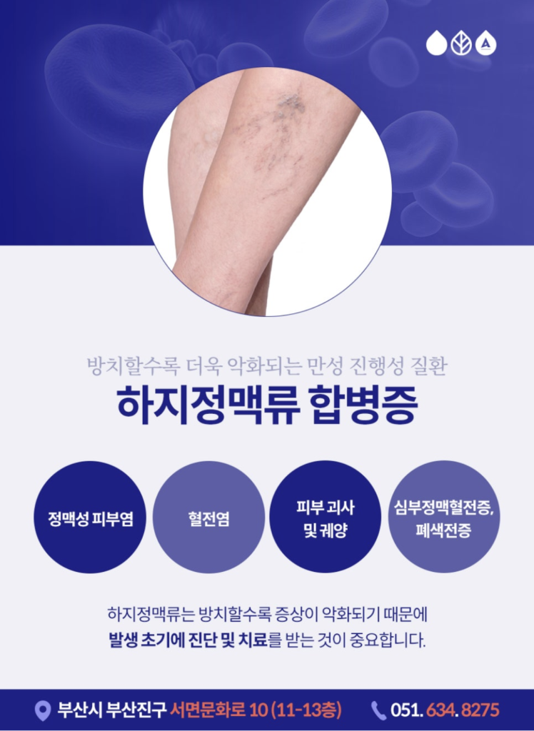 하지정맥다리실핏줄 이전에는 심하지 않았던 다리실핏줄 이 점점 퍼져나간다면, 또 푸른 혈관이 도드라져 보이거나 울퉁불퉁 튀어나온다면 하지정맥류를 의심해보셔야 합니다.